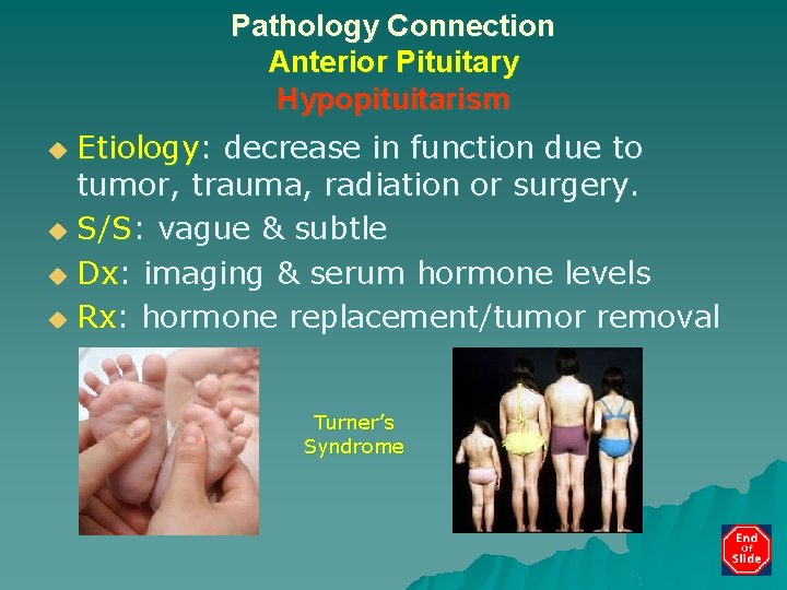 Pathology Connection Anterior Pituitary Hypopituitarism Etiology: decrease in function due to tumor, trauma, radiation