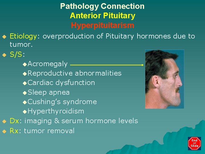 Pathology Connection Anterior Pituitary Hyperpituitarism u u Etiology: overproduction of Pituitary hormones due to