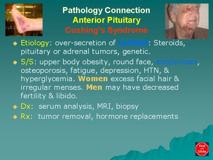 Pathology Connection Anterior Pituitary Cushing’s Syndrome u u Etiology: over-secretion of cortisol: Steroids, pituitary