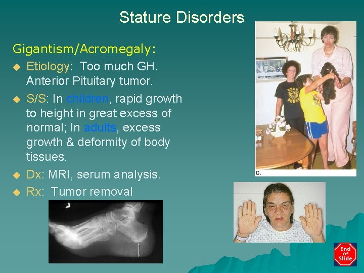 Stature Disorders Gigantism/Acromegaly: u Etiology: Too much GH. Anterior Pituitary tumor. u S/S: In