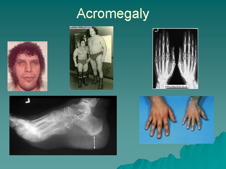 Acromegaly 
