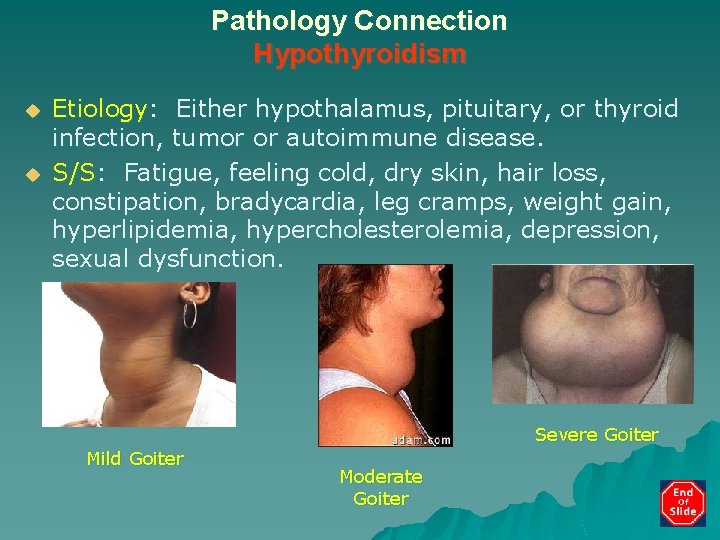 Pathology Connection Hypothyroidism u u Etiology: Either hypothalamus, pituitary, or thyroid infection, tumor or
