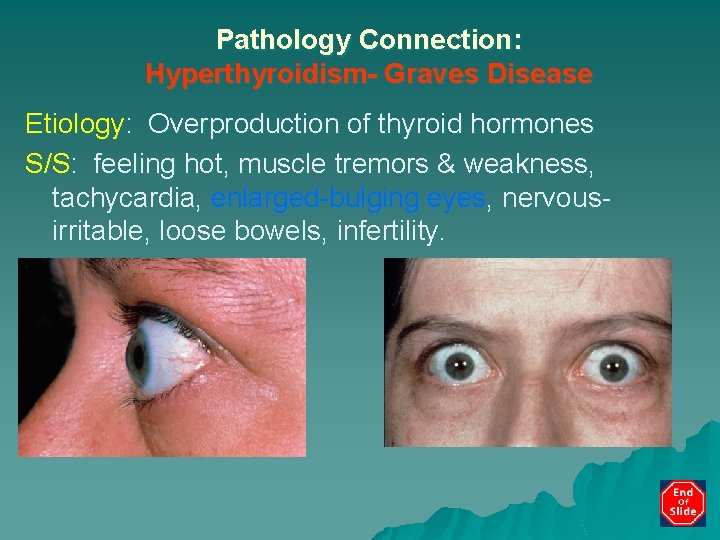 Pathology Connection: Hyperthyroidism- Graves Disease Etiology: Overproduction of thyroid hormones S/S: feeling hot, muscle