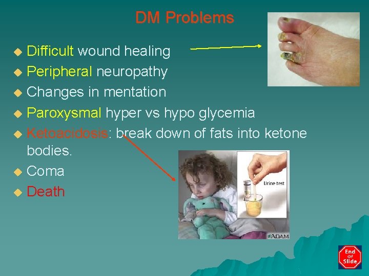 DM Problems Difficult wound healing u Peripheral neuropathy u Changes in mentation u Paroxysmal