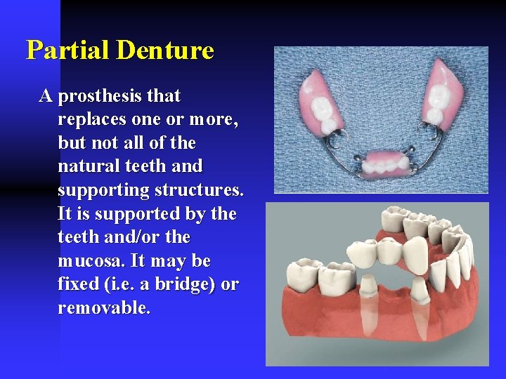 Partial Denture A prosthesis that replaces one or more, but not all of the