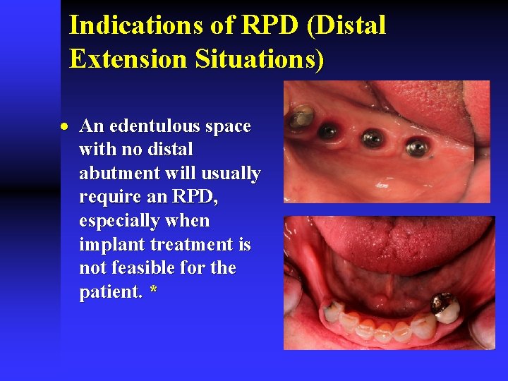 Indications of RPD (Distal Extension Situations) · An edentulous space with no distal abutment