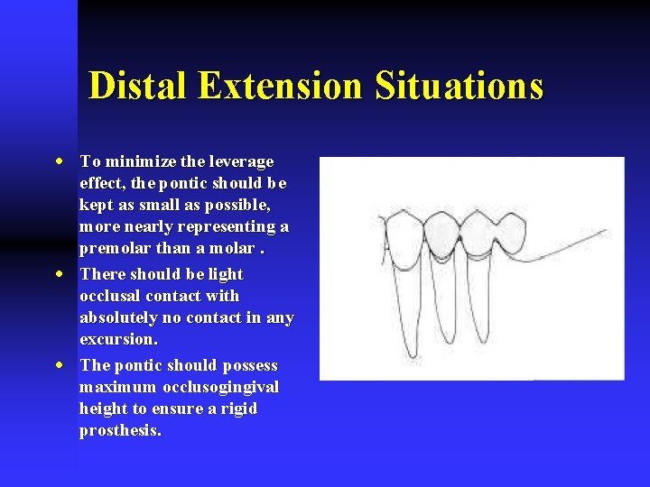 Distal Extension Situations · To minimize the leverage effect, the pontic should be kept