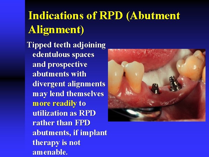 Indications of RPD (Abutment Alignment) Tipped teeth adjoining edentulous spaces and prospective abutments with