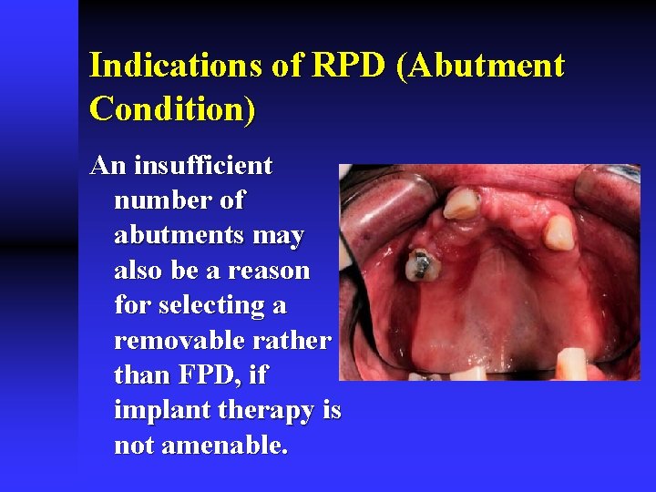 Indications of RPD (Abutment Condition) An insufficient number of abutments may also be a