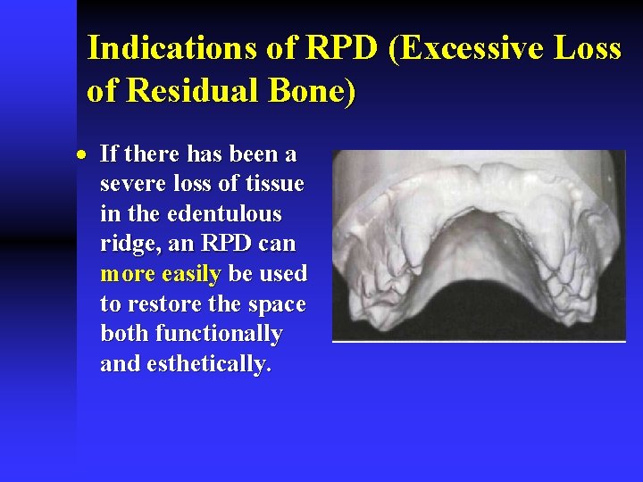 Indications of RPD (Excessive Loss of Residual Bone) · If there has been a