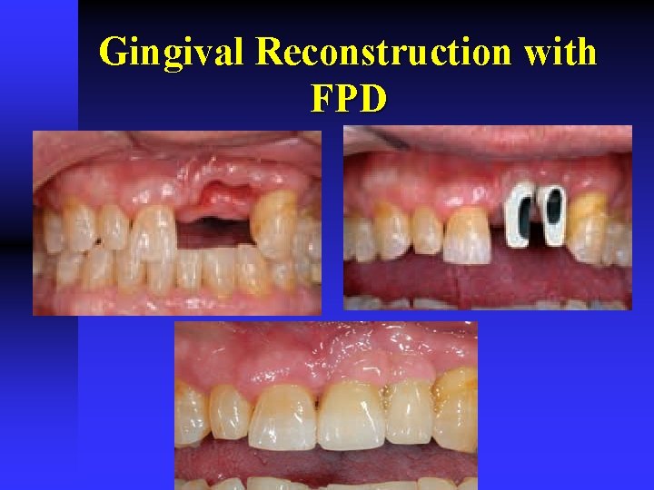 Gingival Reconstruction with FPD 