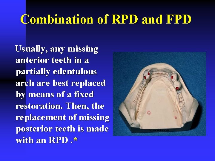 Combination of RPD and FPD Usually, any missing anterior teeth in a partially edentulous
