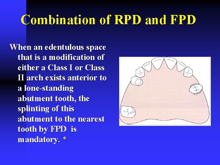 Combination of RPD and FPD When an edentulous space that is a modification of