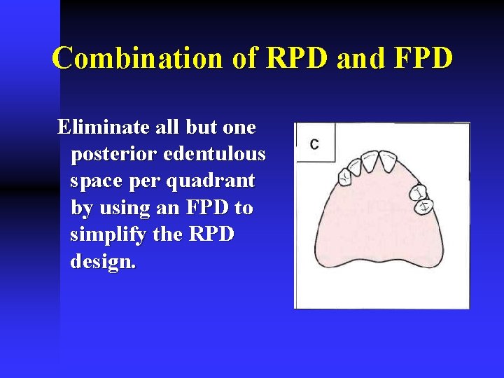 Combination of RPD and FPD Eliminate all but one posterior edentulous space per quadrant