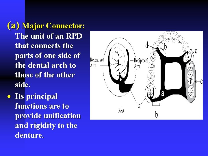 (a) Major Connector: The unit of an RPD that connects the parts of one