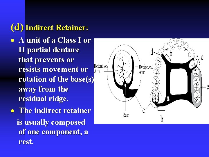 (d) Indirect Retainer: · A unit of a Class I or II partial denture