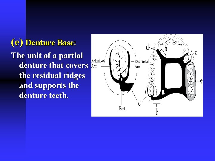 (e) Denture Base: The unit of a partial denture that covers the residual ridges