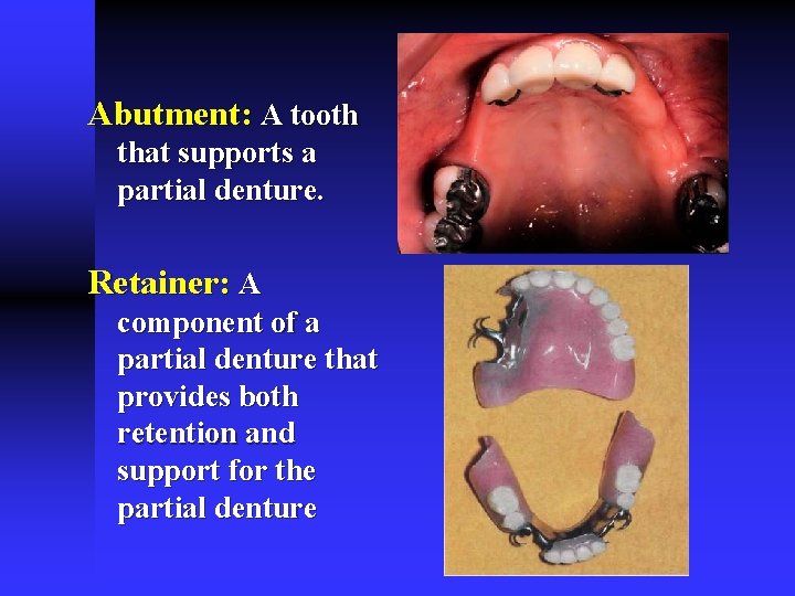 Abutment: A tooth that supports a partial denture. Retainer: A component of a partial