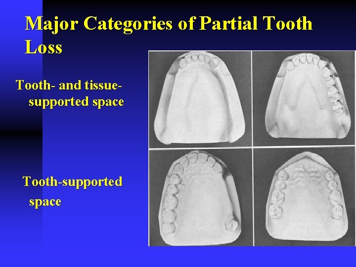 Major Categories of Partial Tooth Loss Tooth- and tissuesupported space Tooth-supported space 