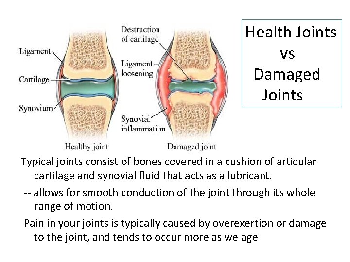 Health Joints vs Damaged Joints Typical joints consist of bones covered in a cushion