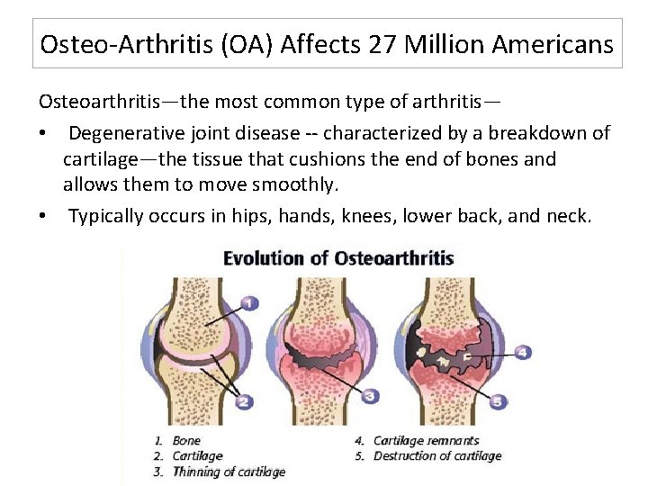 Osteo-Arthritis (OA) Affects 27 Million Americans Osteoarthritis—the most common type of arthritis— • Degenerative