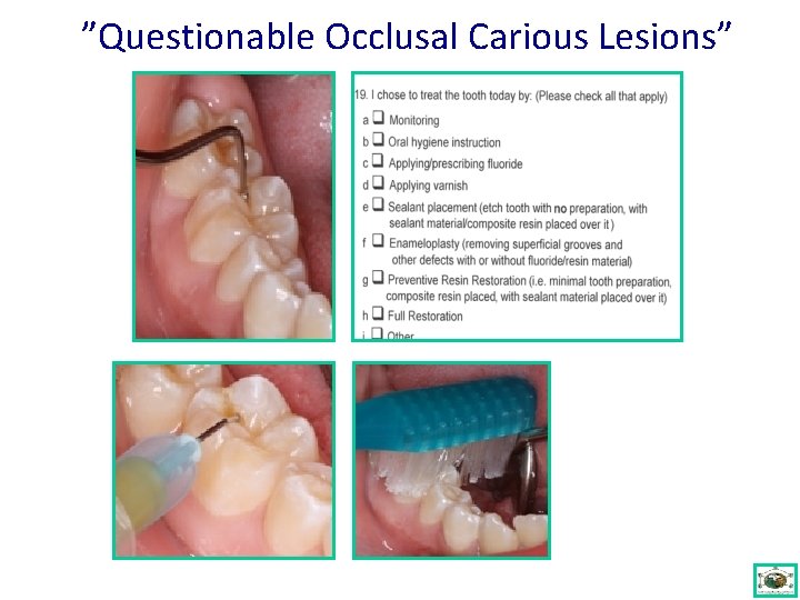 ”Questionable Occlusal Carious Lesions” 