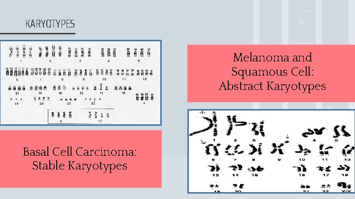 KARYOTYPES Melanoma and Squamous Cell: Abstract Karyotypes Basal Cell Carcinoma: Stable Karyotypes 3 