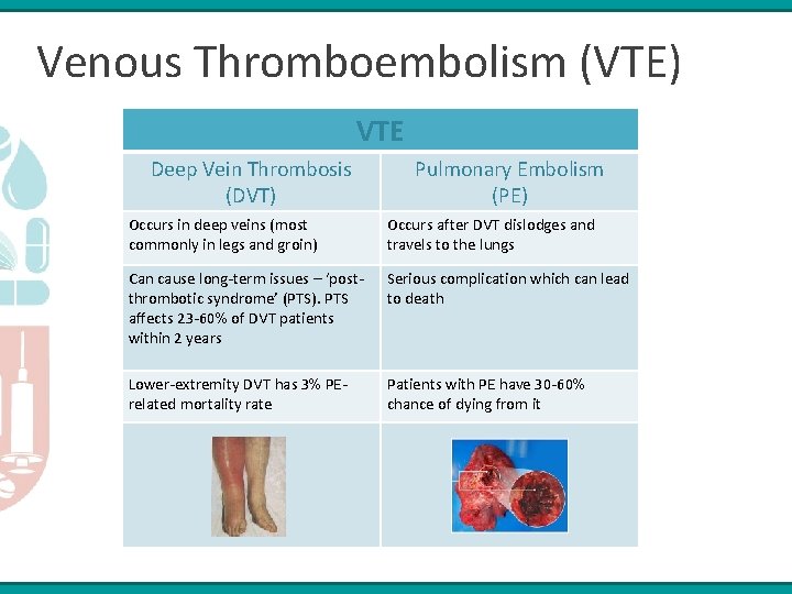 Venous Thromboembolism (VTE) VTE Deep Vein Thrombosis (DVT) Pulmonary Embolism (PE) Occurs in deep
