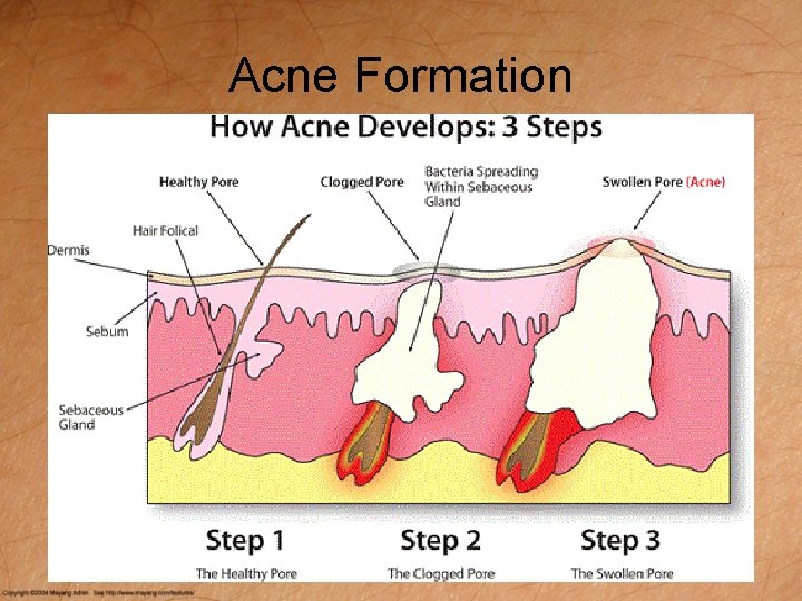 Acne Formation 