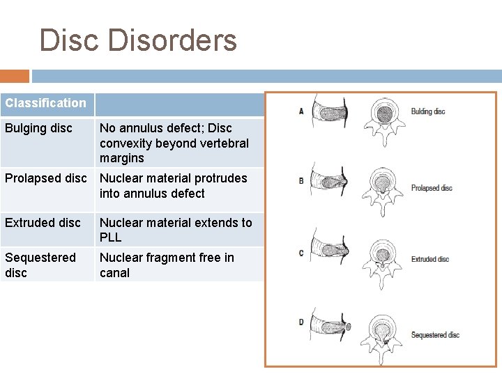 Disc Disorders Classification Bulging disc No annulus defect; Disc convexity beyond vertebral margins Prolapsed