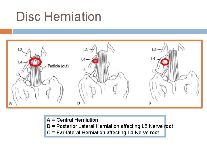 Disc Herniation A = Central Herniation B = Posterior Lateral Herniation affecting L 5