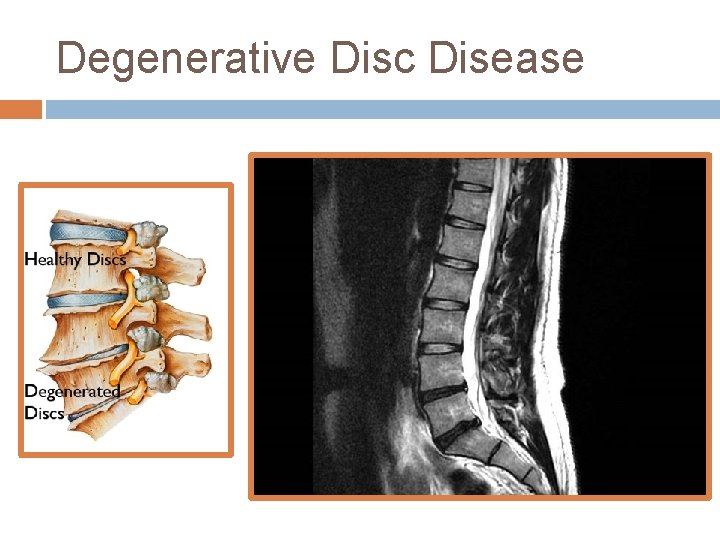 Degenerative Disc Disease 