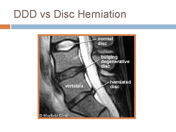 DDD vs Disc Herniation 