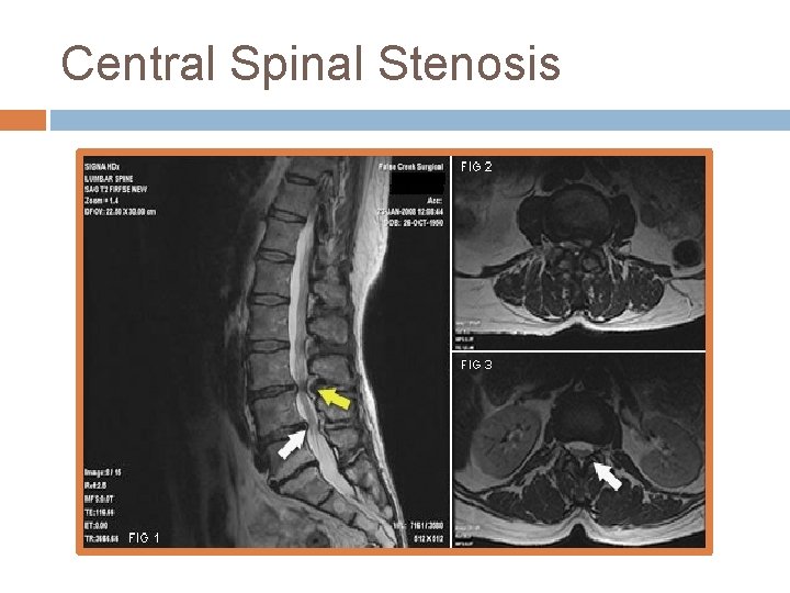 Central Spinal Stenosis 