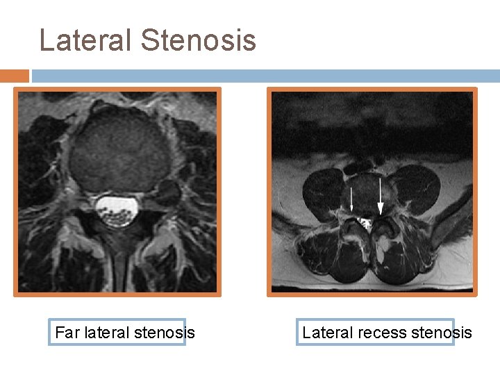 Lateral Stenosis Far lateral stenosis Lateral recess stenosis 