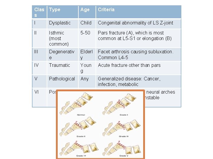 Clas s Type Age Criteria I Dysplastic Child Congenital abnormality of LS Z-joint II