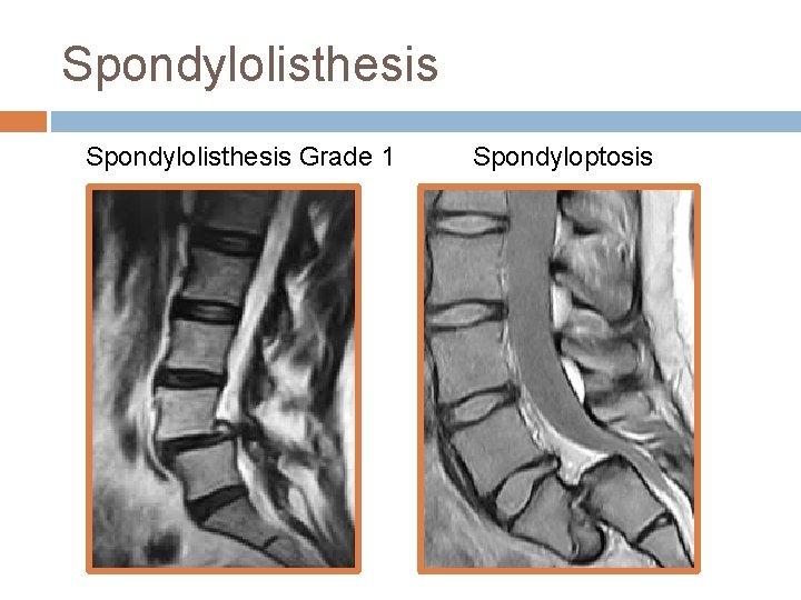 Spondylolisthesis Grade 1 Spondyloptosis 