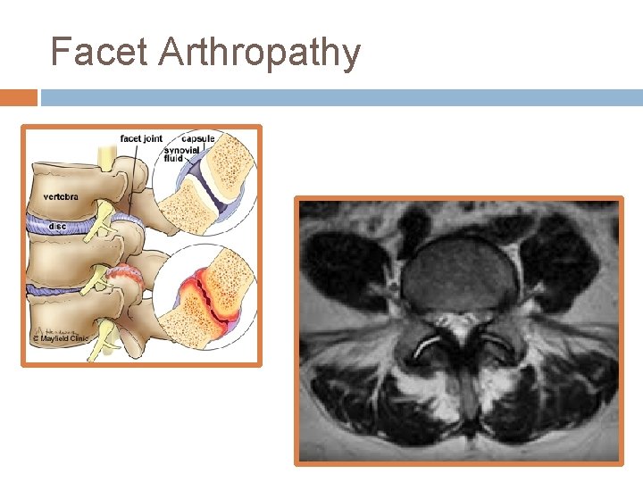 Facet Arthropathy 