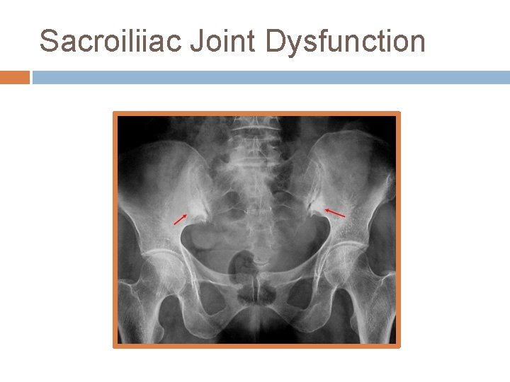 Sacroiliiac Joint Dysfunction 