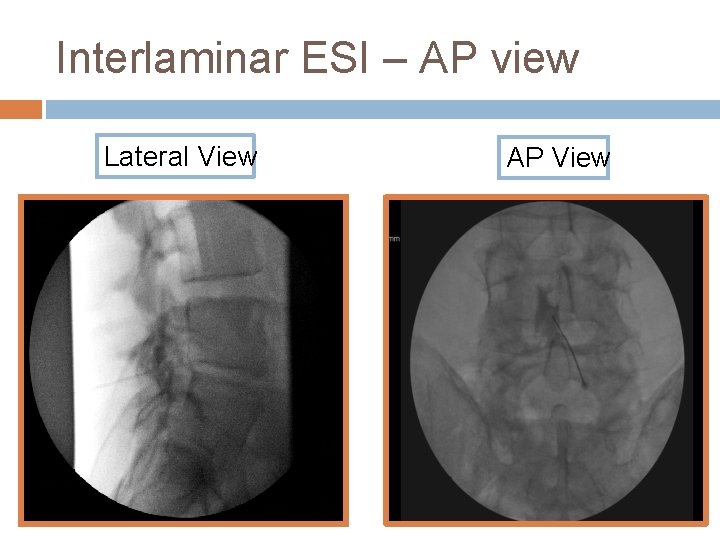 Interlaminar ESI – AP view Lateral View AP View 