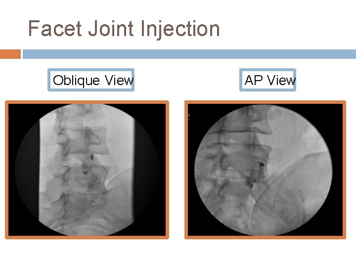 Facet Joint Injection Oblique View AP View 