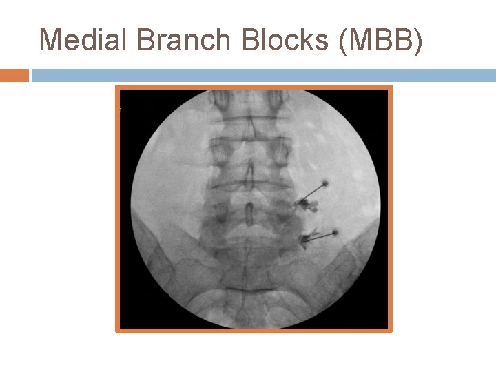 Medial Branch Blocks (MBB) 