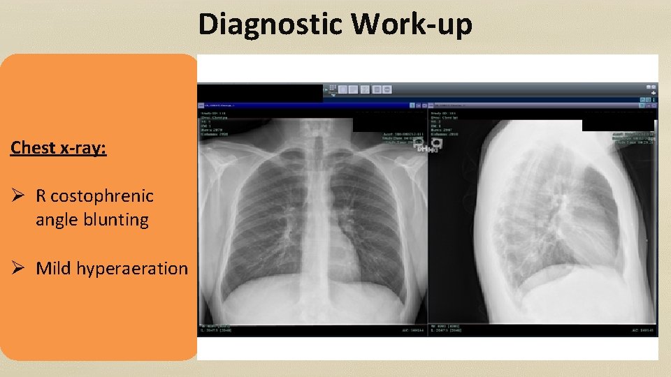 Diagnostic Work-up Chest x-ray: Ø R costophrenic angle blunting Ø Mild hyperaeration 