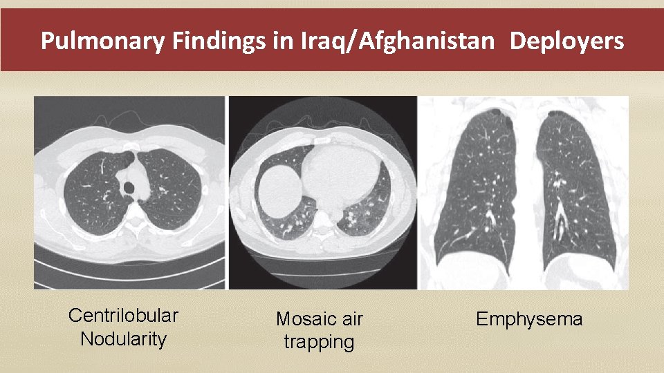 Pulmonary Findings in Iraq/Afghanistan Deployers Centrilobular Nodularity Mosaic air trapping Emphysema 