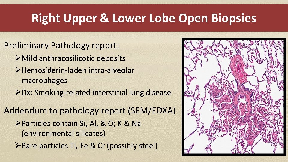 Right Upper & Lower Lobe Open Biopsies Preliminary Pathology report: ØMild anthracosilicotic deposits ØHemosiderin-laden