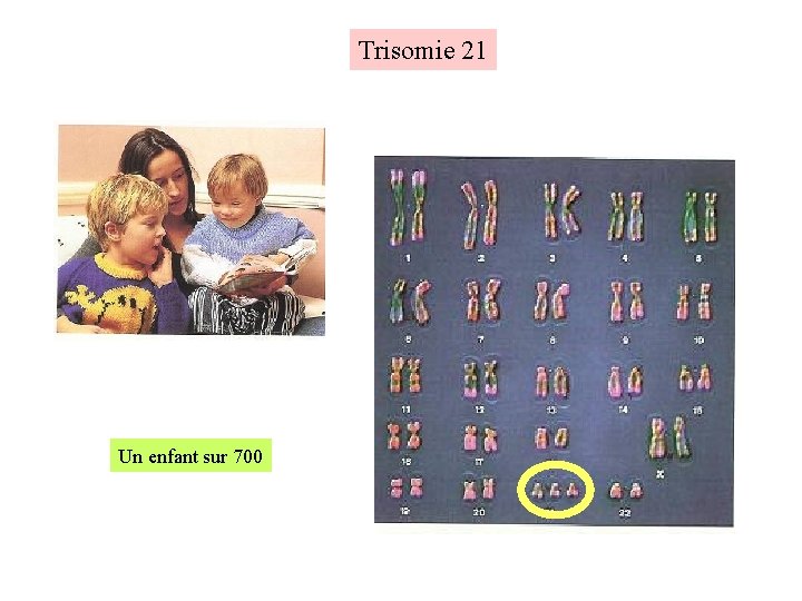 Trisomie 21 Un enfant sur 700 