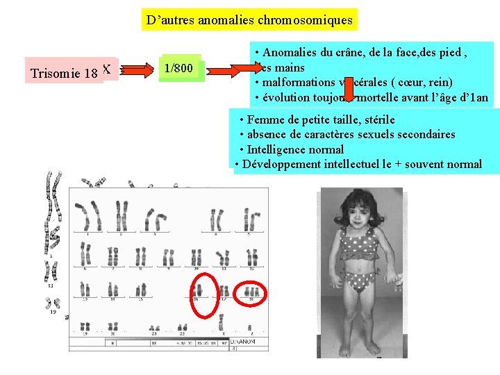 D’autres anomalies chromosomiques Monosomie Trisomie XXY 18 X 1/800 1/5000 • Anomalies du crâne,