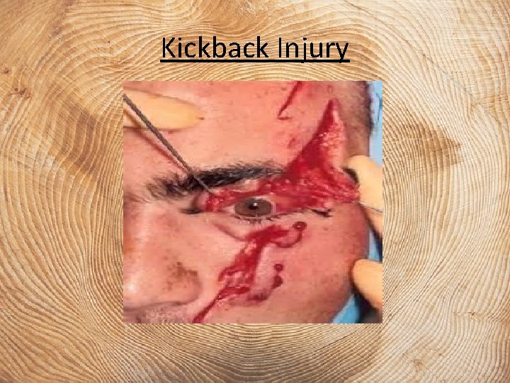 Kickback Injury 