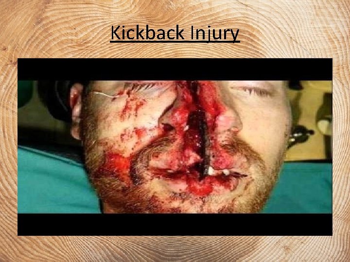 Kickback Injury 