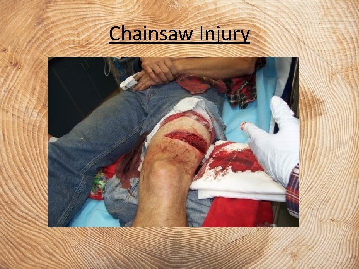 Chainsaw Injury 